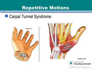 Repetitive Motions
 Carpal Tunnel Syndrome
 