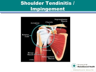 Shoulder Tendinitis /
Impingement
 