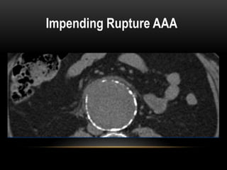 CT Imaging examination about aorta and it's disease | PPT