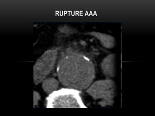 CT Imaging examination about aorta and it's disease | PPT
