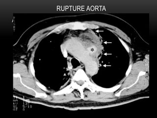 CT Imaging examination about aorta and it's disease | PPT