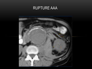 CT Imaging examination about aorta and it's disease | PPT