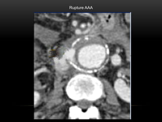 CT Imaging examination about aorta and it's disease | PPT