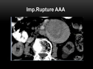 CT Imaging examination about aorta and it's disease | PPT