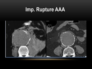 CT Imaging examination about aorta and it's disease | PPT