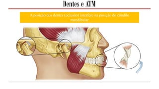 Dentes e ATM
A posição dos dentes (oclusão) interfere na posição do côndilo
mandibular
 