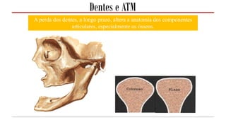 Dentes e ATM
A perda dos dentes, a longo prazo, altera a anatomia dos componentes
articulares, especialmente os ósseos.
 