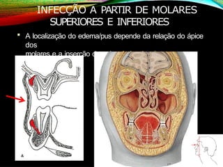 INFECÇÃO A PARTIR DE MOLARES
SUPERIORES E INFERIORES
 A localização do edema/pus depende da relação do ápice
dos
molares e a inserção do músculo bucinador
 