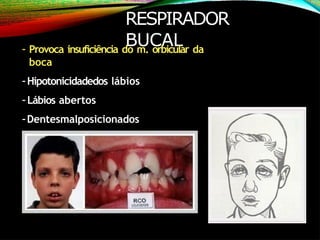 RESPIRADOR
BUCAL
- Provoca insuficiência do m. orbicular da
boca
-Hipotonicidadedos lábios
- Lábios abertos
-Dentesmalposicionados
 