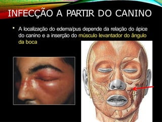 INFECÇÃO A PARTIR DO CANINO
 A localização do edema/pus depende da relação do ápice
do canino e a inserção do músculo levantador do ângulo
da boca
 