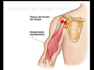  El tendon de la cabeza larga del
biceps braquial envuelto por
una vaina sinovial, se mueve
adelante y atrás es el surco
interbertubercular del humero.
El desgaste y la ruptura de este
mecanismo pueden causar
dolor en el hombro,
generalmente inflamacion del
tendon. El resultado de
microtraumatismos repetitivos
en deportes que implican
lanzamientos (ej. Beisbol y el
cricket) y el uso de
raquetas(tenis)
Tendinitis del biceps braquial
 