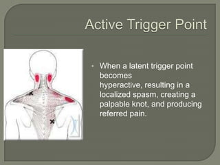• When a latent trigger point
becomes
hyperactive, resulting in a
localized spasm, creating a
palpable knot, and producing
referred pain.
 