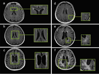 MRI differential diagnosis of Multiple sclerosis | PPTX