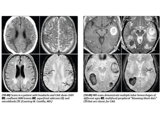 MRI differential diagnosis of Multiple sclerosis | PPTX