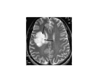 MRI differential diagnosis of Multiple sclerosis | PPTX