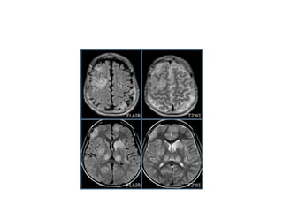 MRI differential diagnosis of Multiple sclerosis | PPTX