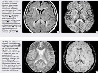 MRI differential diagnosis of Multiple sclerosis | PPTX
