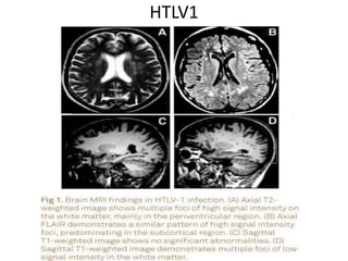 MRI differential diagnosis of Multiple sclerosis | PPTX