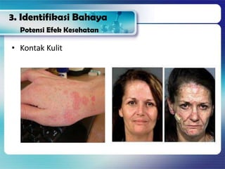 3. Identifikasi Bahaya
Potensi Efek Kesehatan
• Kontak Kulit
 
