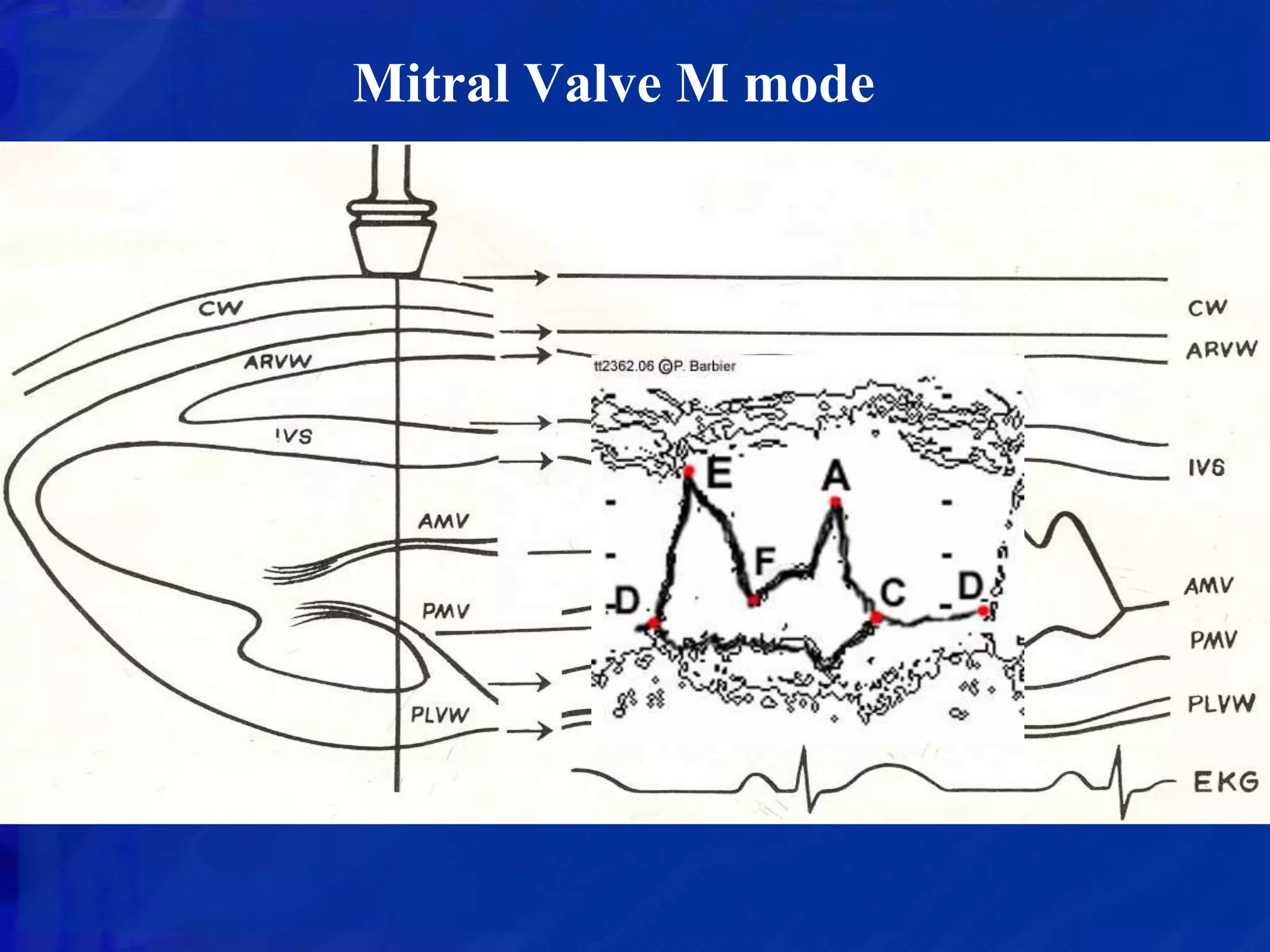 ECHOCARDIOGRAPHIC EVALUATION OF MITRAL VALVE DISEASE | PPTX