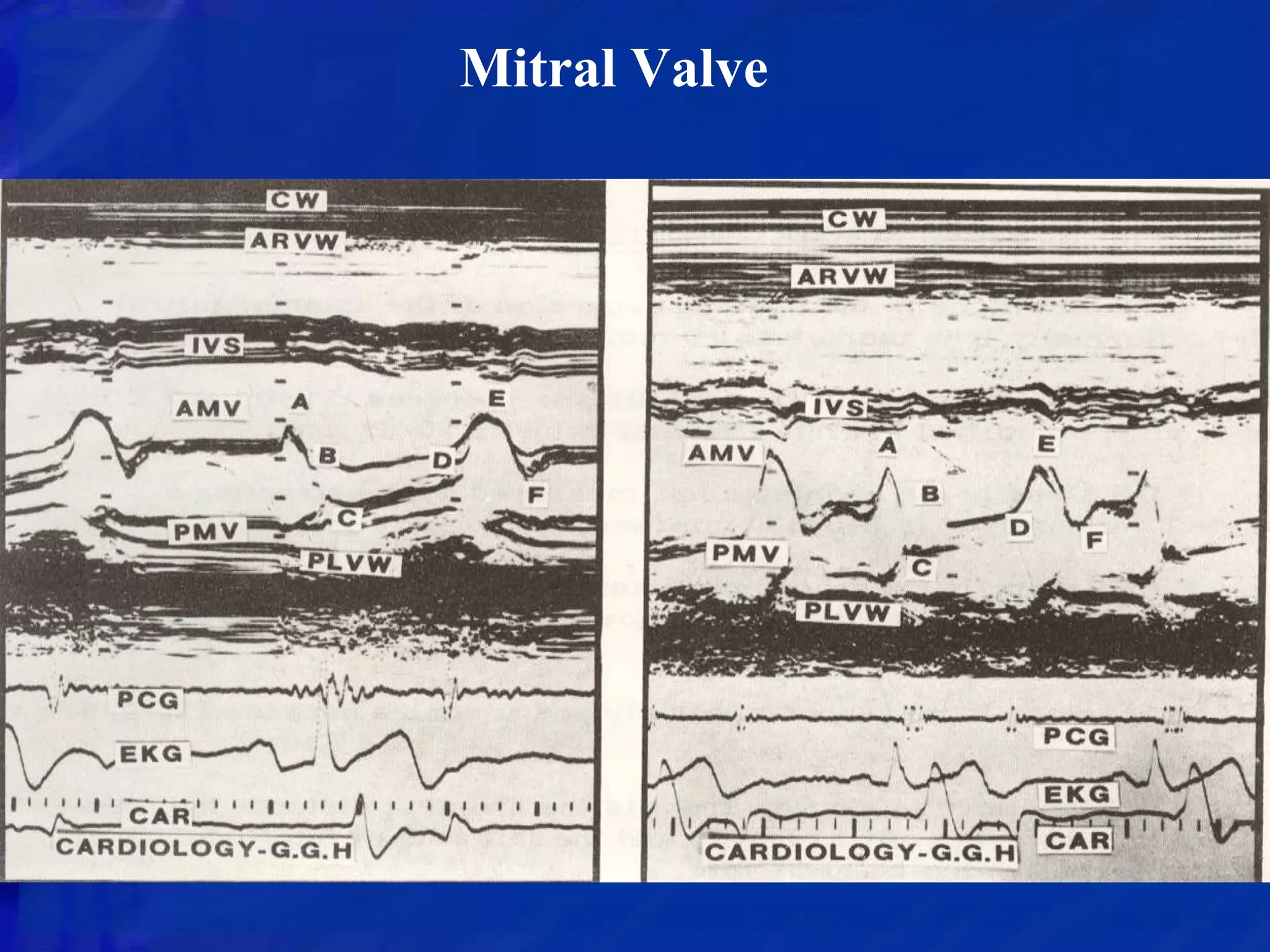ECHOCARDIOGRAPHIC EVALUATION OF MITRAL VALVE DISEASE | PPTX