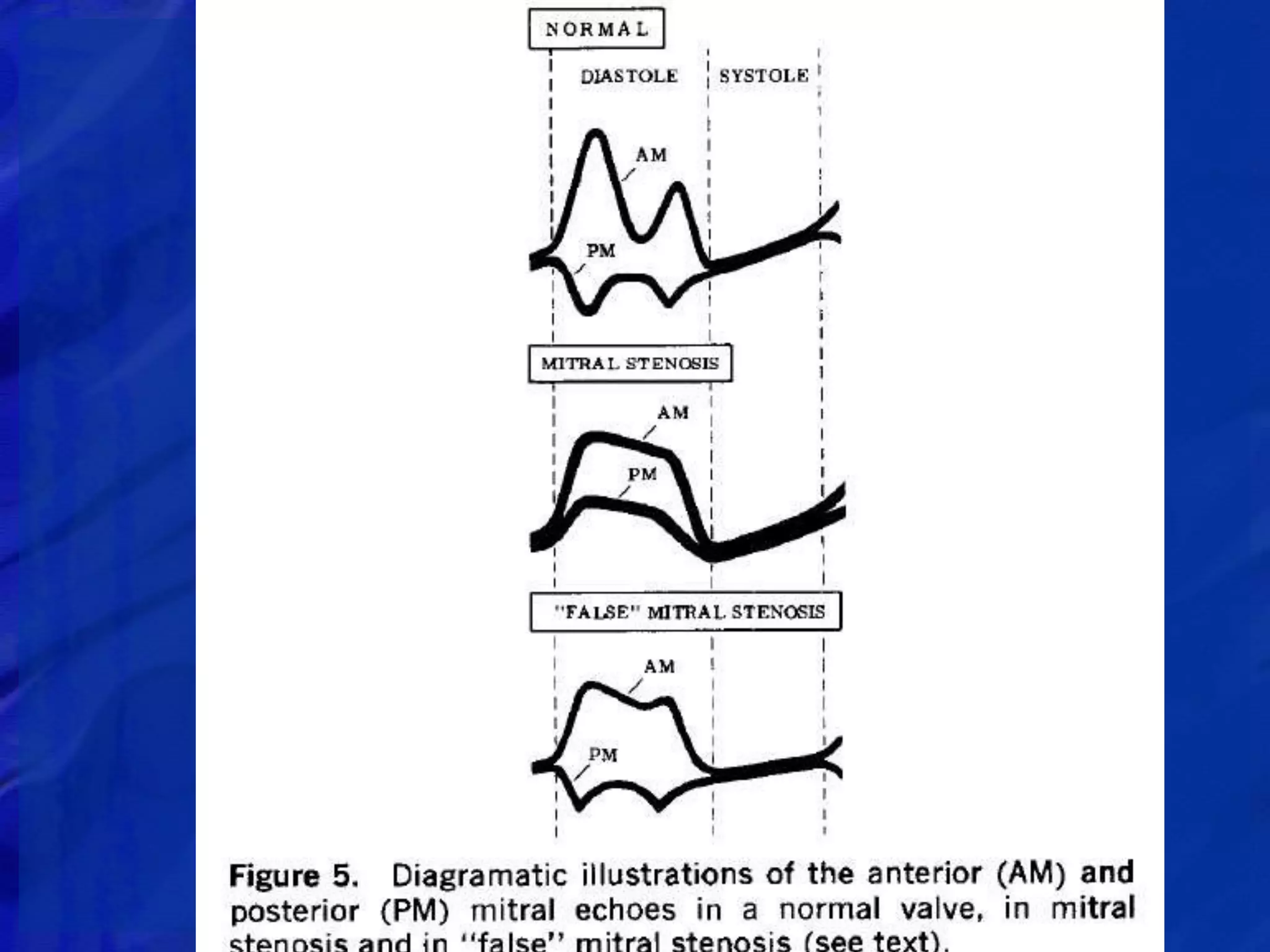 ECHOCARDIOGRAPHIC EVALUATION OF MITRAL VALVE DISEASE | PPTX