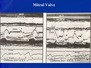 ECHOCARDIOGRAPHIC EVALUATION OF MITRAL VALVE DISEASE | PPTX