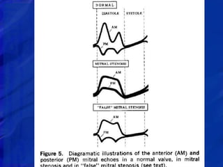 ECHOCARDIOGRAPHIC EVALUATION OF MITRAL VALVE DISEASE | PPTX