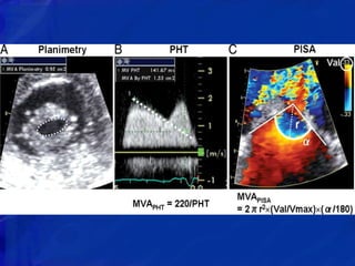 ECHOCARDIOGRAPHIC EVALUATION OF MITRAL VALVE DISEASE | PPTX