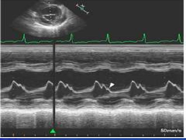ECHOCARDIOGRAPHIC EVALUATION OF MITRAL VALVE DISEASE