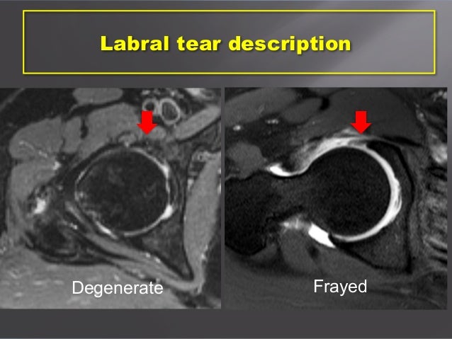 Msk imaging adult hip pain j griffith