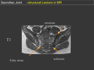 Sacroiliac Joint

–structural Lesions in MR

erosions

T1

Fatty areas

sclerosis

 