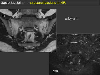 Sacroiliac Joint

T1

–structural Lesions in MR

ankylosis

 