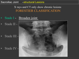 Sacroiliac Joint

–structural Lesions

X rays and CT only show chronic lesions

FORESTIER CLASSIFICATION

•  Stade I - Broaden joint
•  Stade II - stamps
•  Stade III - cloody

•  Stade IV - Fusion

 