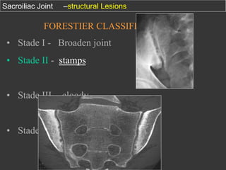 Sacroiliac Joint

–structural Lesions

FORESTIER CLASSIFICATION

•  Stade I - Broaden joint
•  Stade II - stamps
•  Stade III - cloody

•  Stade IV - Fusion

 