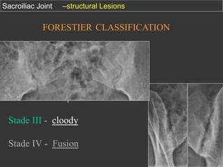 Sacroiliac Joint

–structural Lesions

FORESTIER CLASSIFICATION

Stade I - Broaden joint
Stade II - stamps
Stade III - cloody
Stade IV - Fusion

 