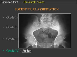 Sacroiliac Joint

– Structural Lesions

FORESTIER CLASSIFICATION

•  Grade I - Pseudo – élargissement
•  Grade II - Timbre – poste
•  Grade III - Aspect marécageux

•  Grade IV - Fusion

 