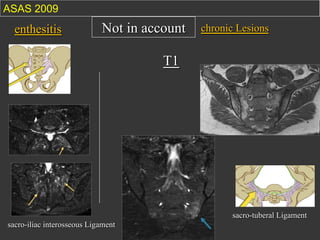 ASAS 2009

enthesitis

Not in account

chronic Lesions

T1

sacro-tuberal Ligament
sacro-iliac interosseous Ligament

 