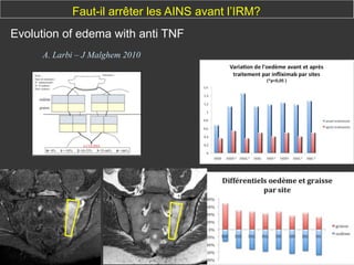 Faut-il arrêter les AINS avant l’IRM?
Evolution of edema with anti TNF
A. Larbi – J Malghem 2010

 