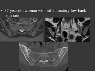 •  37 year old woman with inflammatory low back
pain rate

 