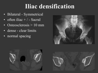 Iliac densification
• 
• 
• 
• 
• 

Bilateral - Symmetrical
often iliac + / - Sacral
Osteosclerosis > 10 mm
dense - clear limits
normal spacing

 