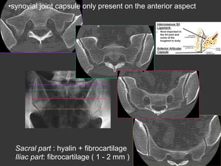 • synovial joint capsule only present on the anterior aspect

Sacral part : hyalin + fibrocartilage ( 2 - 5 mm )
Iliac part: fibrocartilage ( 1 - 2 mm )

 