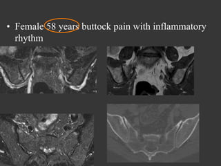 •  Female 58 years buttock pain with inflammatory
rhythm

 
