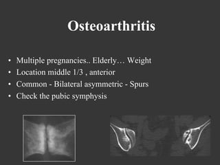 Osteoarthritis
• 
• 
• 
• 

Multiple pregnancies.. Elderly… Weight
Location middle 1/3 , anterior
Common - Bilateral asymmetric - Spurs
Check the pubic symphysis

 