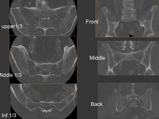 upper1/3

Front

Middle

Middle 1/3

Back
Inf 1/3

 