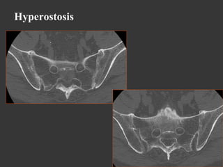 Hyperostosis

 