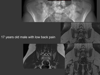 17 years old male with low back pain

 