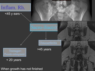 Inflam. Rh.
<45 y ears

HyperParaTh

drugs

Sacro-iliac(s)?
Osteoarthritis
Teenager:

>45 years

Pseudo-enlargment

< 20 years
When growth has not finished

Infectious

 