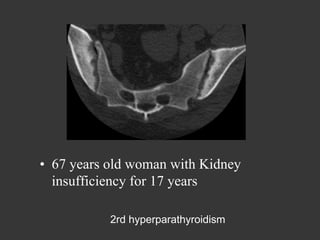 •  67 years old woman with Kidney
insufficiency for 17 years
2rd hyperparathyroidism

 