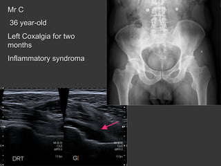 Mr C
36 year-old
Left Coxalgia for two
months
Inflammatory syndroma

 